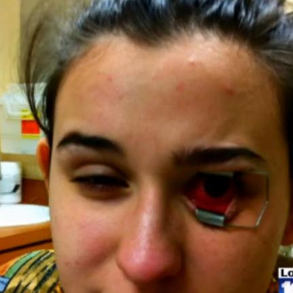 контактные линзы,глаза,паразиты, Студентка не снимавшая линзы полгода - ослепла